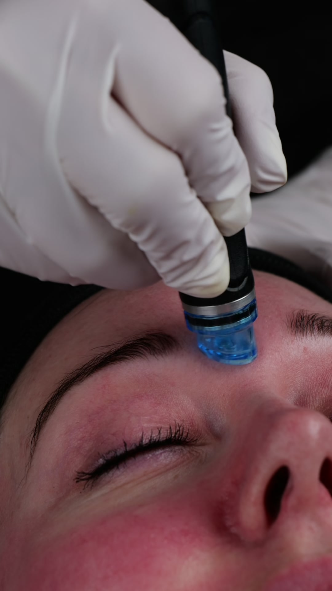 HydraFacial Hautstruktur Verbesserung bei Muse Body Shape Institute Wohlen