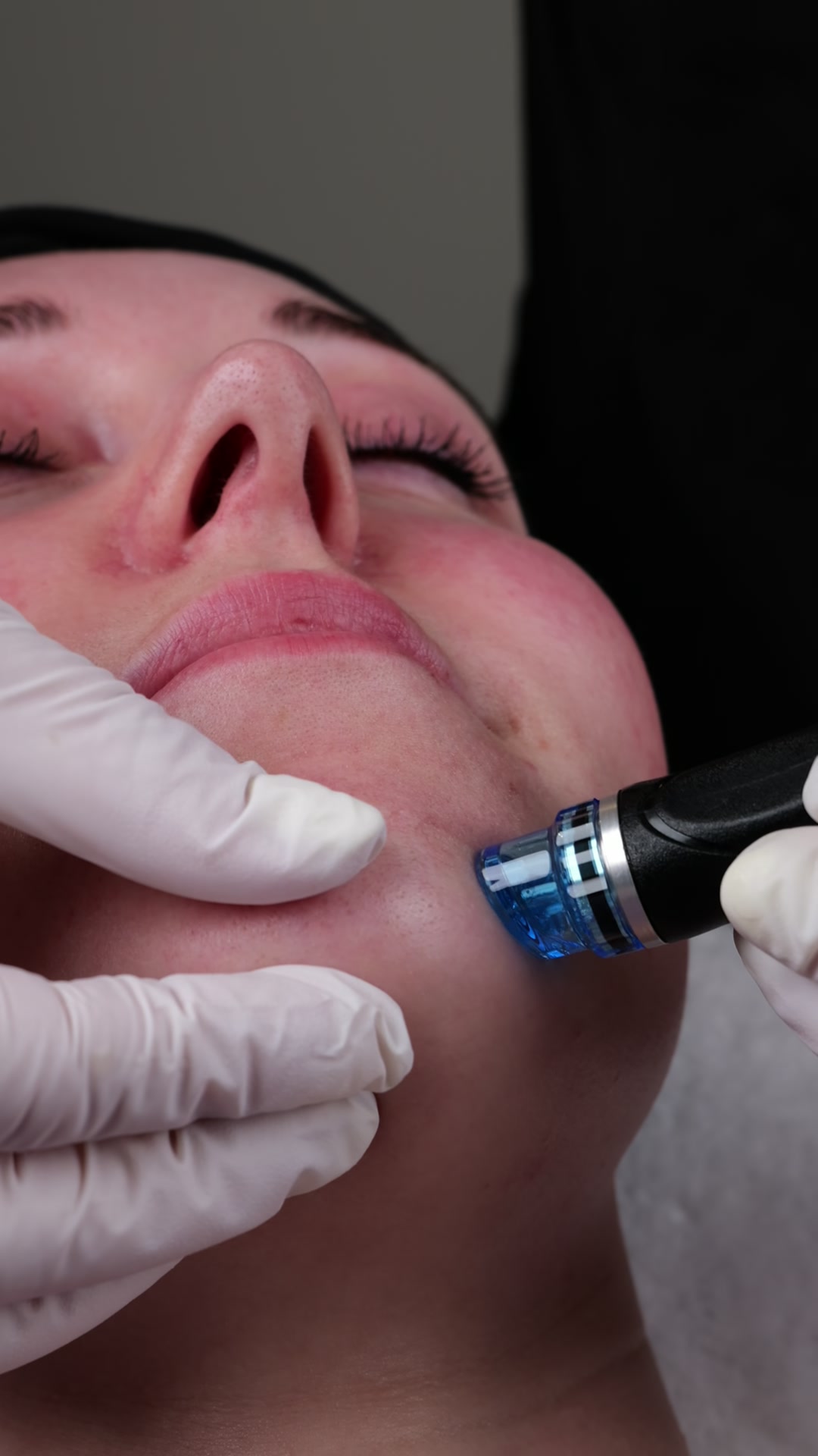 HydraFacial ebenmässiger Teint bei Muse Body Shape Institute Wohlen